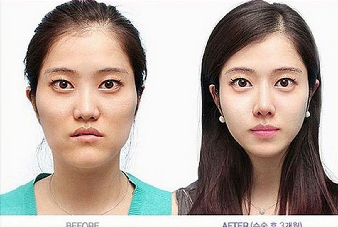 Porn Asian Plastic Surgery